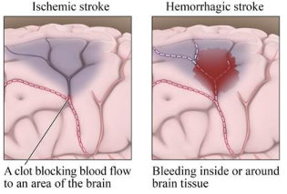 figure illustrates difference between ischemic stroke and hemorrhagic stroke in which a clot blocks blood flow in ischemic stroke and rupture of blood vessels brings up exposure of brain cells to irritating effects of blood in hemorrhagic stroke