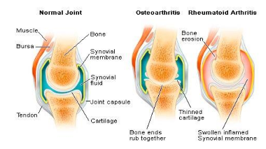 image shows Difference in osteoarthritis and rheumatoid arthritis in contrast to the normal joint