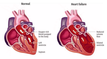 Diagrammatic representation of left ventricular heart failure with enlarged ventricle