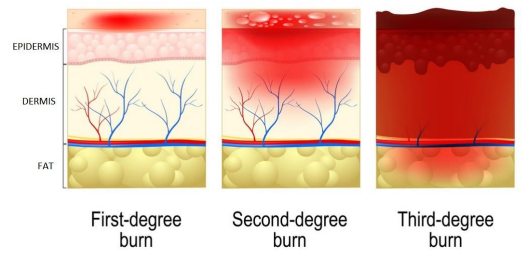 Types and degrees of burn